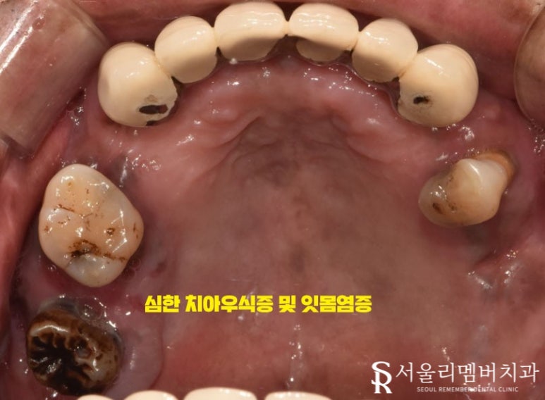오래된 보철을 방치하면 결국 임플란트 식립밖에 남지 않게 됩니다! 봉천역 리멤버 치과 관련 이미지 3