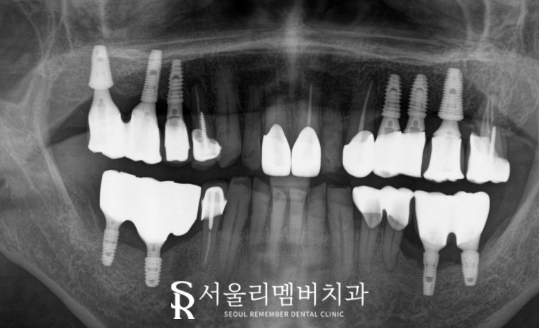 임플란트 및 크라운 으로 구강 환경 개선하는 방법 - 서울대입구역 치과 관련 이미지 7