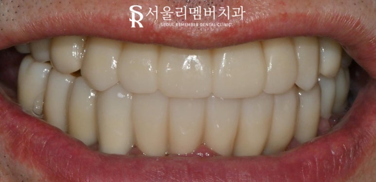 신대방 치과 에서 전악 수면마취 임플란트 수술로 전체 치아 회복시켜드렸습니다. 관련 이미지 8