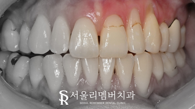 "잇몸이 점점 드러나는 느낌이 들어요." 서울대입구역치과 당일 레진 치료 관련 이미지 1