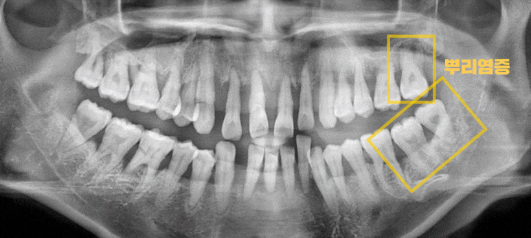 밝게 웃어본 적이 언젠지.. 낙성대역 서울 리멤버 치과 에서 잃어버린 미소를 찾아드렸습니다. 관련 이미지 2