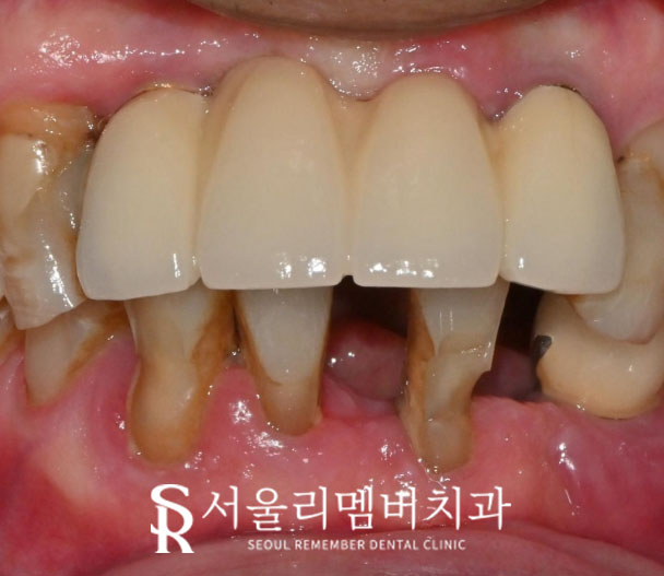 아래 앞니 임플란트 수명 얼마나 될까? 서울대입구역치과 에서 제대로 된 치료 받으세요. 관련 이미지 1