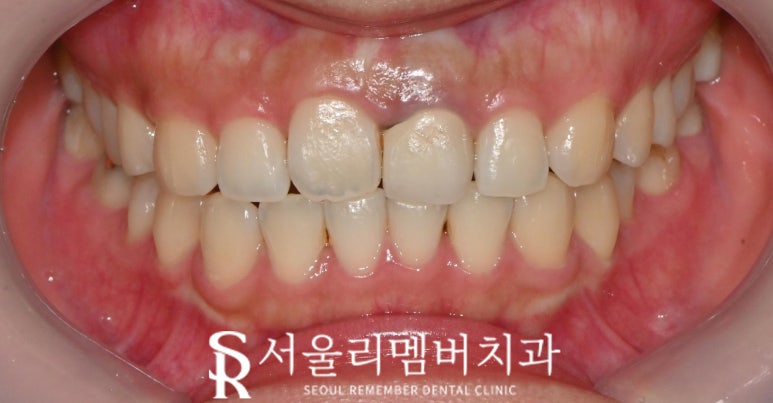 신림 치과 인비절라인 투명교정 후 크라운까지 관련 이미지 2
