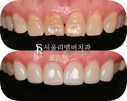상도동 치과 누렇게 보이는 앞니 6전치 심미보철 라미 리얼네이트로 밝고 자연스럽게 개선한 사례 관련 이미지 1