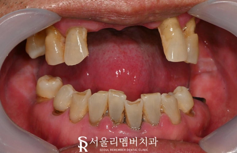 사당 치과 하악 전치 신경치료 브릿지로 살리고 나머지 임플란트로 재건한 전악 증례 관련 이미지 6