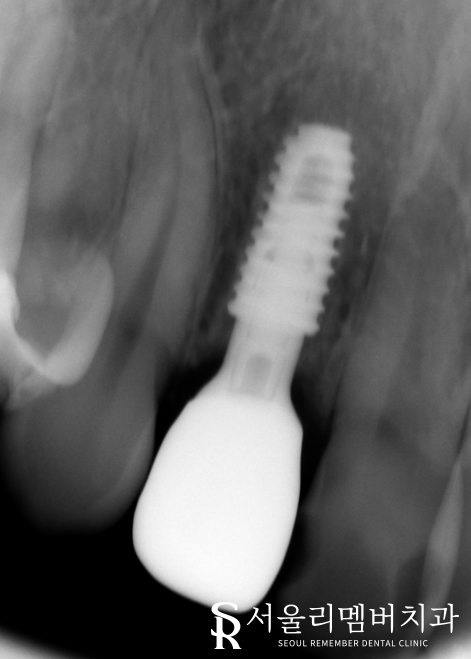 어? 전에 올려놨던 앞니 크라운이 갑자기 떨어졌어요 ! 신길동 치과 관련 이미지 5