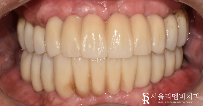 오래된 보철을 방치하면 결국 임플란트 식립밖에 남지 않게 됩니다! 봉천역 리멤버 치과 관련 이미지 9