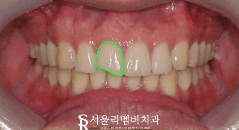 서울대입구역 치과 외상으로 깨진 앞니 당일 레진 치료 후기 관련 이미지 1