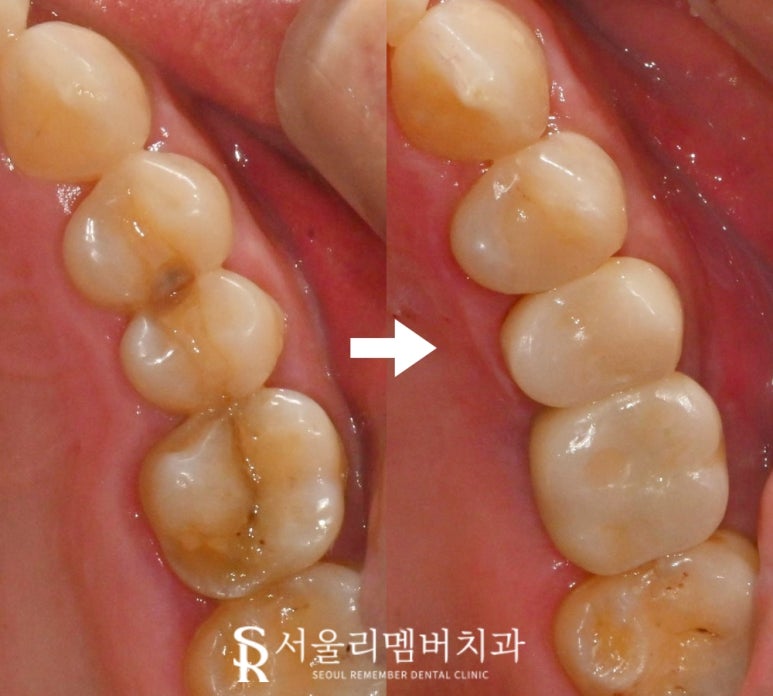 서울대입구 치과 치아 파절로 인한 신경치료 크라운 및 씹을때 통증으로 발치 후 임플란트 관련 이미지 1