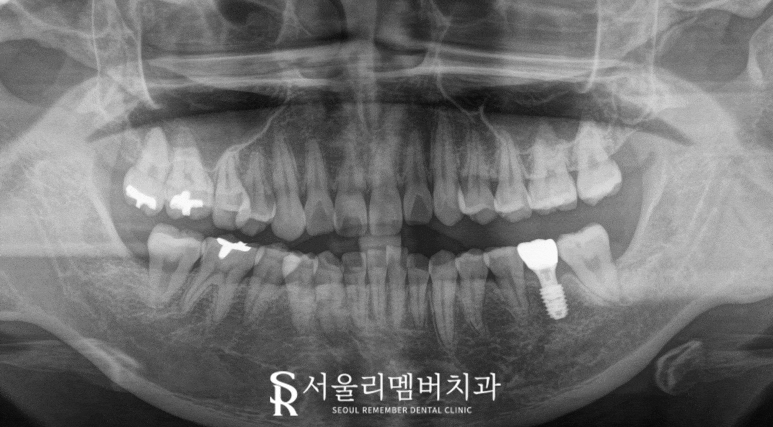 상실된 작은 어금니와 사랑니가 있을 때, 사당 치과 임플란트 및 안전한 발치 과정은? 관련 이미지 3