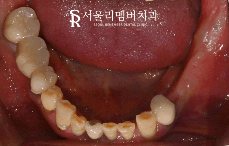왼쪽 아래 어금니 임플란트 브릿지 장점, 진행 과정, 빨리 치료해야 되는 이유 상도동 치과 관련 이미지 2