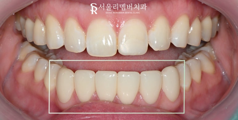 하악 전치 벌어진 공간 스페이스 해소를 위한 아래 앞니 6전치 리얼네이트 라미네이트 케이스 관련 이미지 8