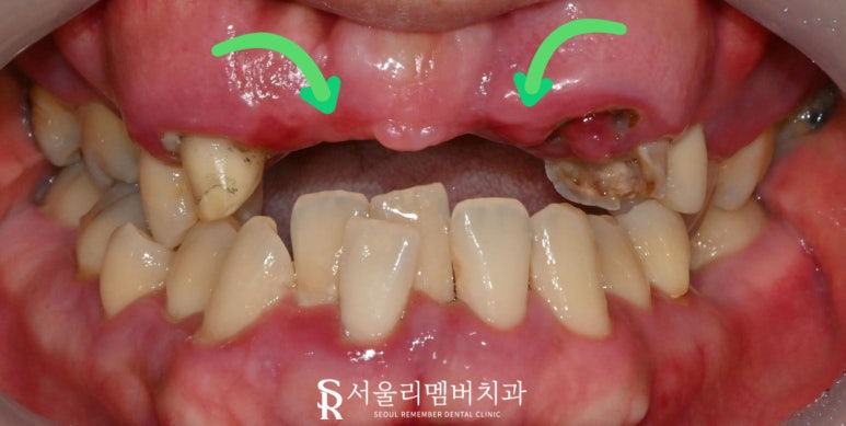때늦은 치료, 임플란트와 크라운으로 바로잡는 서울대입구역 치과 관련 이미지 2