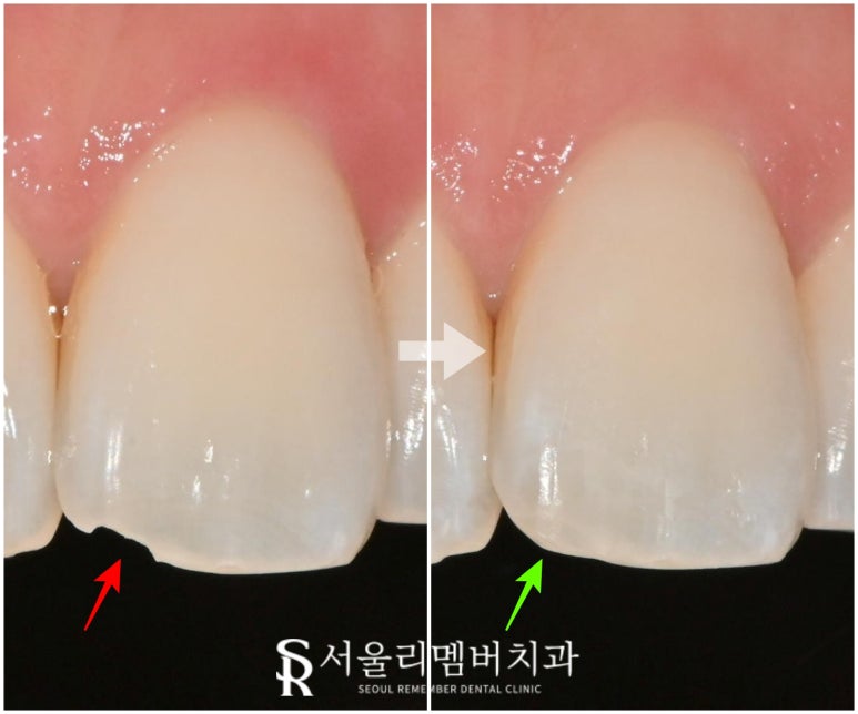 앞니 끝 살짝 깨짐, 보라매 치과 당일 레진으로 비용 부담 없이 1회 내원만에 복원 가능할까? 관련 이미지 4
