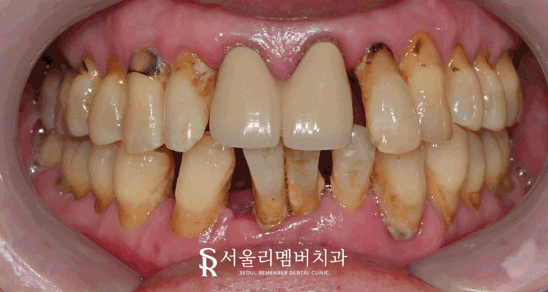서울대입구역 치과 잇몸이 내려앉아서 고민이라면 전악 임플란트로 해결 관련 이미지 7