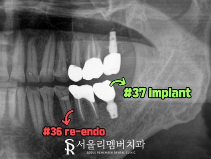 제 기능하지 못하는 오래된 브릿지 보철 제거 후 재신경치료와 임플란트 로 어금니 통증 해결 서울대입구역 치과 관련 이미지 2