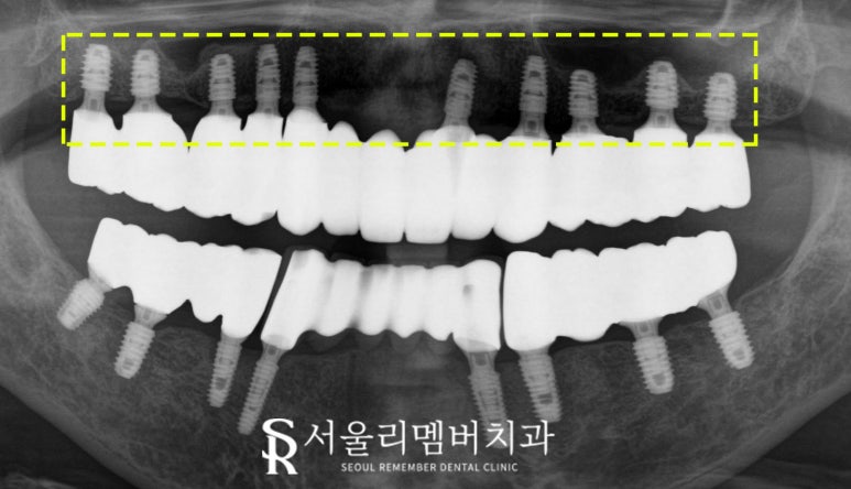 임플란트로 구강환경개선 신림역 치과 에서 깔끔하게 치료한 케이스 관련 이미지 4