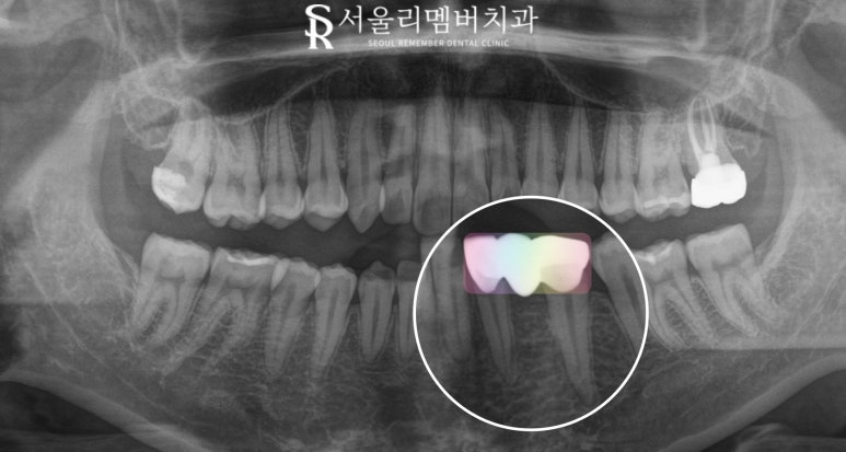 서울대입구역 치과 선천적 영구치 결손으로 잔존 유치 발치 후 브릿지 수복 케이스 관련 이미지 3