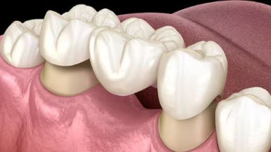 봉천동 치과 에서 신경치료 및 브릿지로 깨진 치아 회복하기 관련 이미지 3