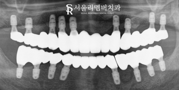 여러 곳이 결손된 치아 서울대입구역 치과 에서 다수 임플란트 식립으로 불편감을 개선해 드린 케이스 관련 이미지 5