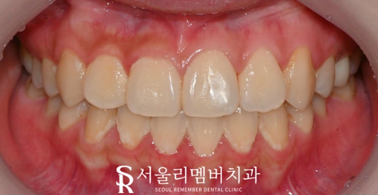 사당역 치과 리얼네이트 심미보철 라미네이트로 누렇고 약한 앞니부터 작은 어금니까지 변화 관련 이미지 2