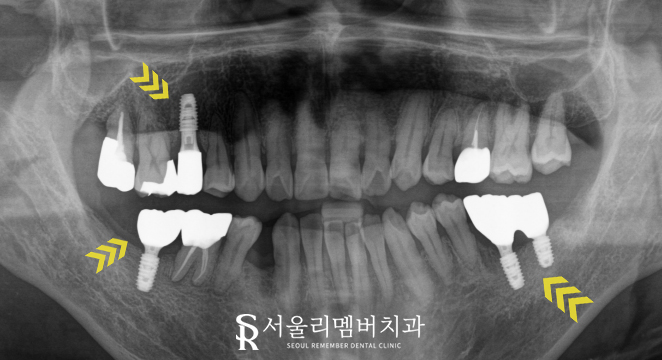 신림역 치과, 어금니 임플란트 및 보철 치료로 심미 저작 기능 개선 과정 관련 이미지 6