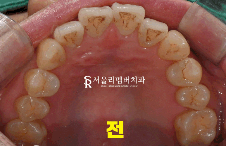 서울대입구역 치과 이렇게만 해도 치아 수명을 늘릴 수 있습니다 관련 이미지 5