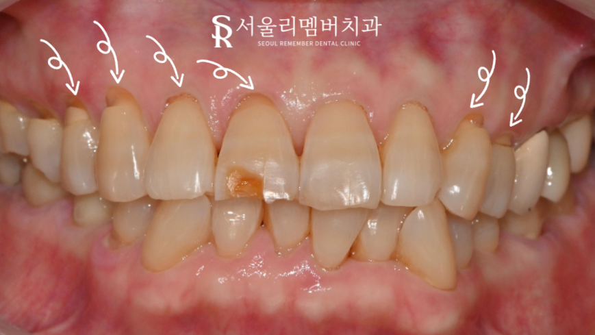 봉천역 치과 깨진 앞니와 치경부 마모, 레진 당일 수복 증례 관련 이미지 2