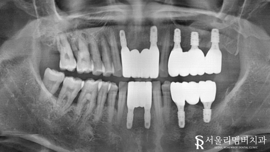 치석이 발치로 이어질 수 있다는 말, 사실일까요?! 봉천동 서울 리멤버 치과 관련 이미지 10