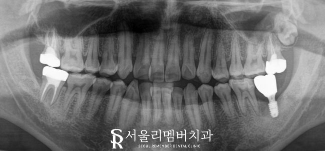 사당역 치과 신경치료와 임플란트로 건강한 치아 되찾기 관련 이미지 3