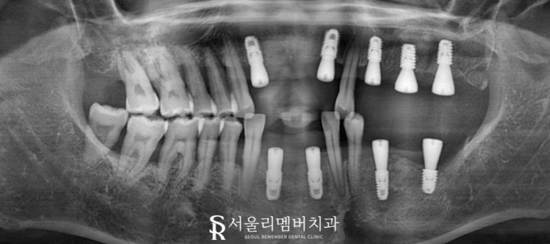 치석이 발치로 이어질 수 있다는 말, 사실일까요?! 봉천동 서울 리멤버 치과 관련 이미지 5