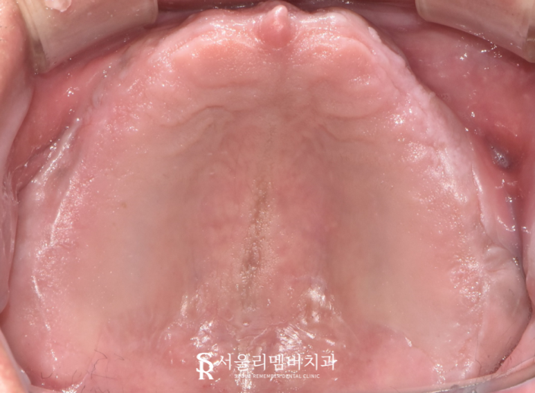 서울대입구역 치과 무너진 수직 고경 어떻게 개선했을까? 관련 이미지 2