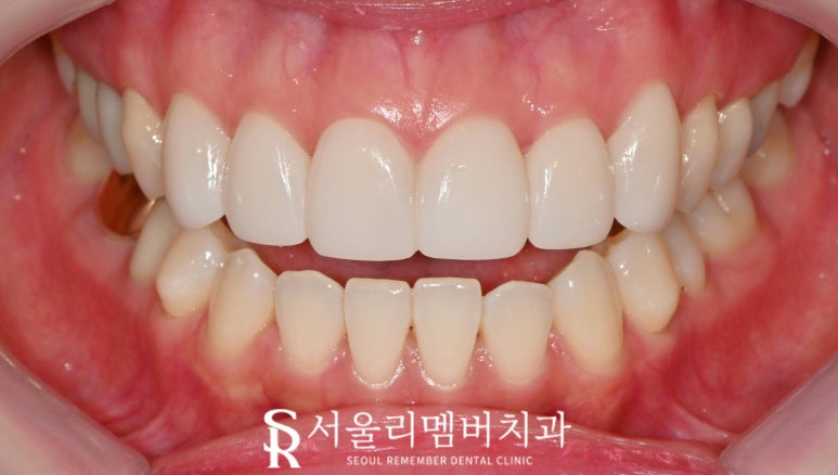 Concerned About the Color and Shape of Your Front Teeth? Seoul National University Station Dental Clinic—Maxillary Six Anterior Veneers Extending to the Canines image 4