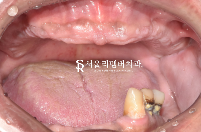 서울대입구역 치과 무너진 수직 고경 어떻게 개선했을까? 관련 이미지 3