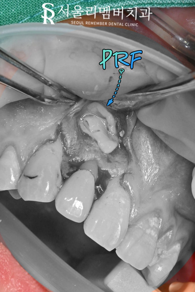 앞니 뿌리 끝 염증, 치근단 절제술(apicoectomy) 보라매 치과 관련 이미지 7