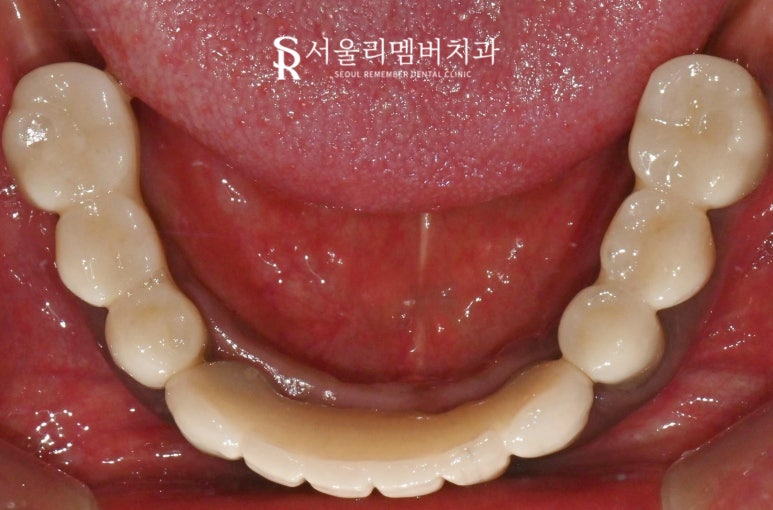 "도저히 음식을 먹지 못해요" 봉천역 치과 수면 임플란트 치료 사례 관련 이미지 6