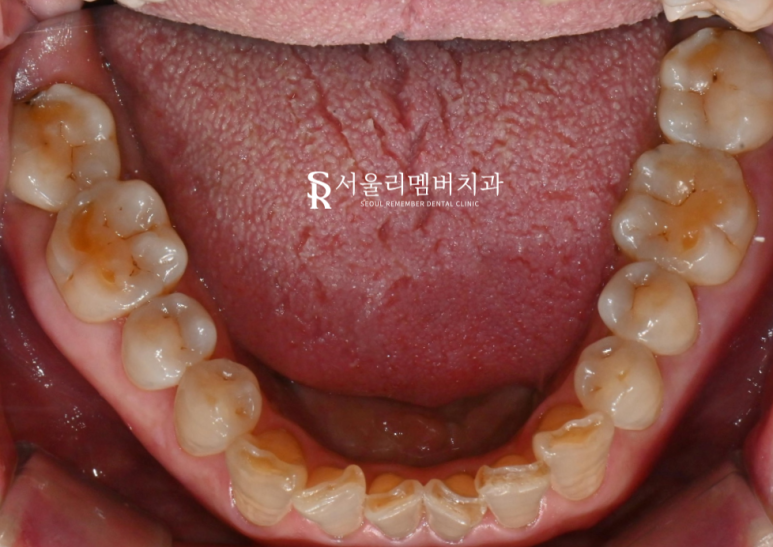 서울대입구역 치과 음식 찌꺼기가 계속 껴요. 관련 이미지 7