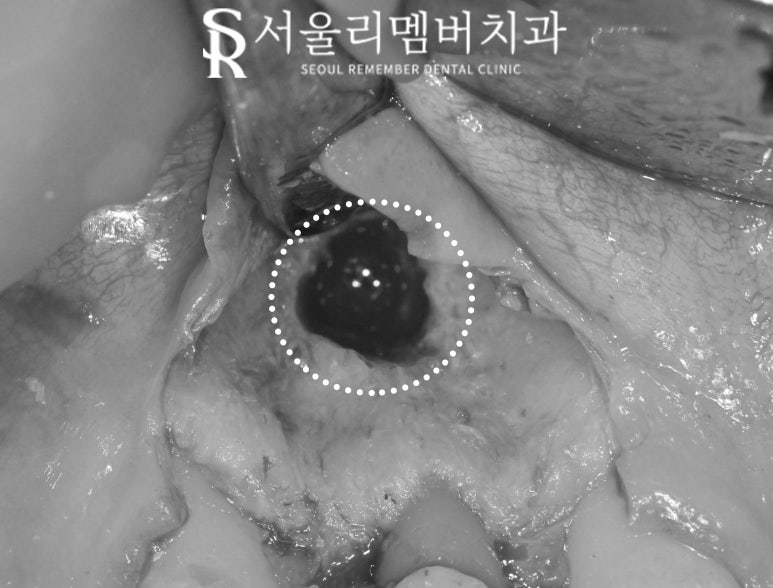 앞니 뿌리 끝 염증, 치근단 절제술(apicoectomy) 보라매 치과 관련 이미지 3