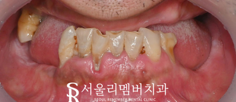 사당 치과, 틀니 대신 전체 임플란트로 새로운 구강 환경 되찾아 드린 사례 관련 이미지 1