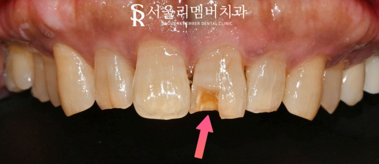 앞니가 깨졌다면? 상도동 치과 신경치료 없이 크라운만으로 자연치아 살리기 관련 이미지 2