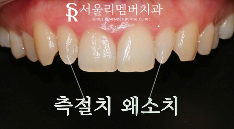 봉천동 치과 작은 앞니 왜소치 최소 삭제 및 통증 손상 없는 리얼 라미네이트 (Laminate)로 6전치 보철 수복 치료 관련 이미지 2