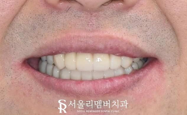상도동 치과 위아래 다수의 치아 상실, 원가이드를 이용한 디지털 임플란트 로 상하악 전체 재건 가능 관련 이미지 8