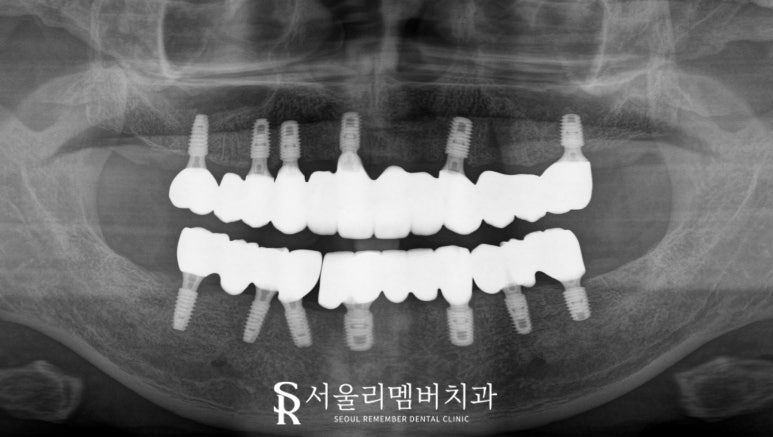 서울대입구역 치과 에서 안전하고 신속 정확하게 발치 후 전악 임플란트 식립한 케이스 관련 이미지 5