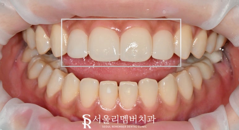 앞니 벌어짐, 레진 말고 라미네이트로 사이 틈새 자연스럽게 채우자 서울대입구 치과 상악 전치부 리얼네이트 케이스 관련 이미지 5