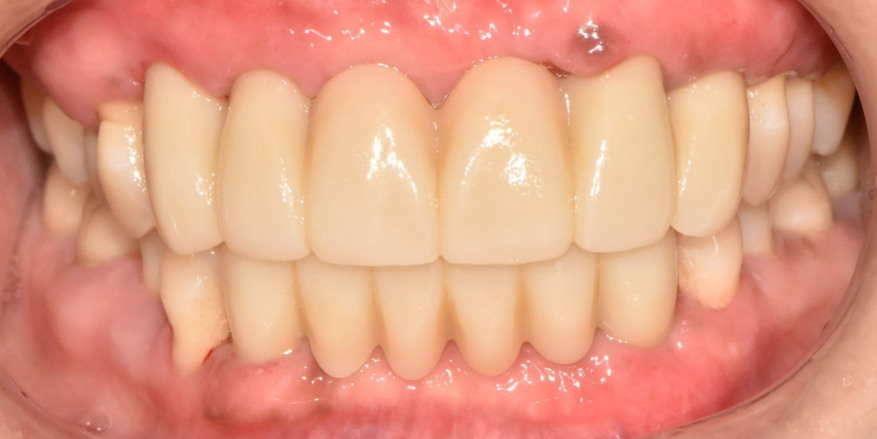 밝게 웃어본 적이 언젠지.. 낙성대역 서울 리멤버 치과 에서 잃어버린 미소를 찾아드렸습니다. 관련 이미지 5