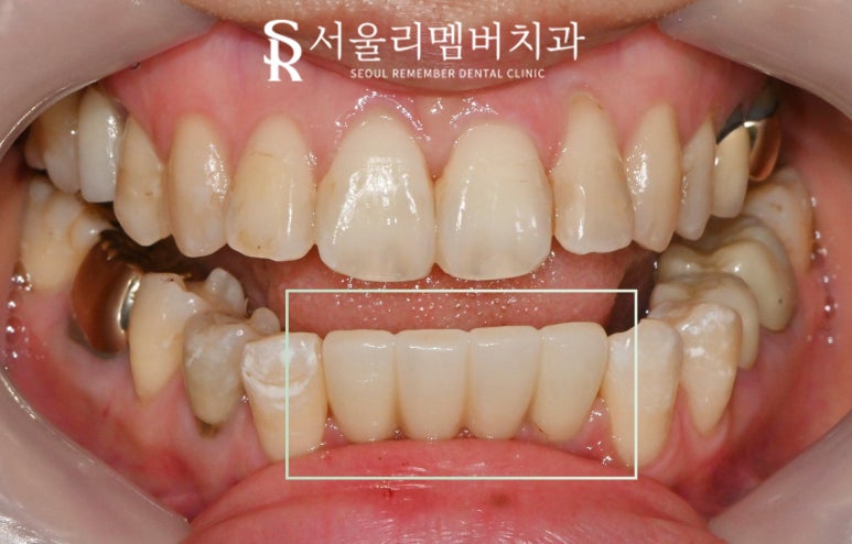 아래 앞니 부러짐 뿌리 끝 염증 봉천동 치과 하악 4전치 발치 후 오스템 임플란트 관련 이미지 7