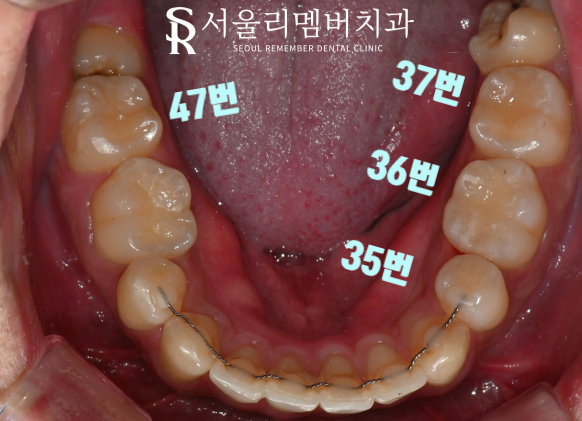 서울대입구치과 상황에 맞는 단계별 충치치료로 구강 고민 해결 완료! 관련 이미지 2