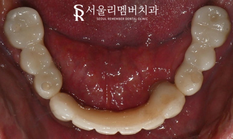 신대방 치과 에서 전악 수면마취 임플란트 수술로 전체 치아 회복시켜드렸습니다. 관련 이미지 7