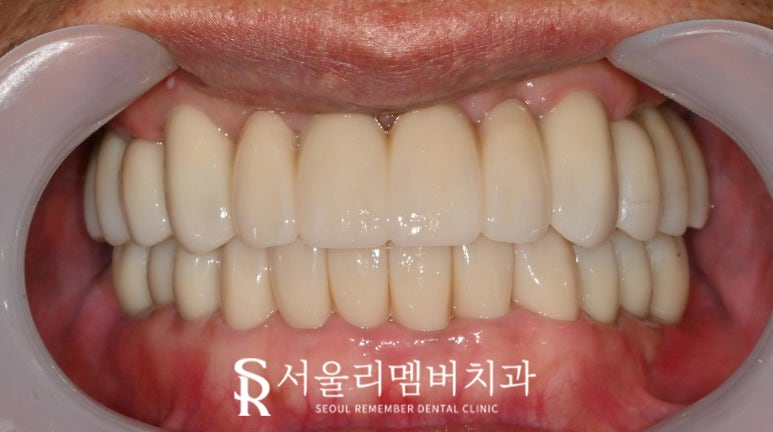 사당 치과 하악 전치 신경치료 브릿지로 살리고 나머지 임플란트로 재건한 전악 증례 관련 이미지 11
