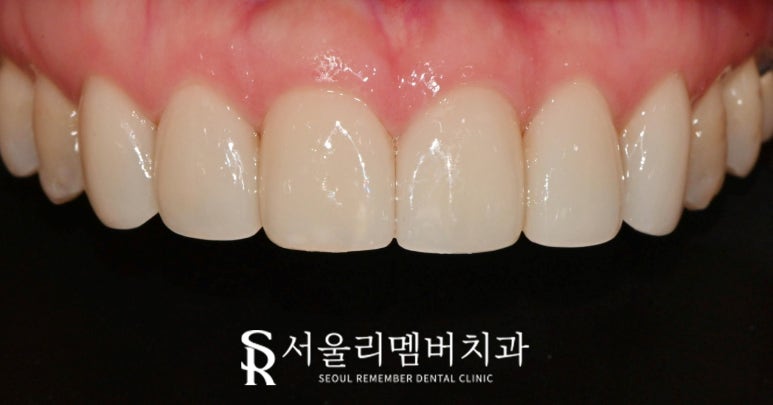 봉천역 치과 파절된 앞니 크라운, 6전치 라미네이트로 심미성 회복하고 환한 미소 되찾기 관련 이미지 2